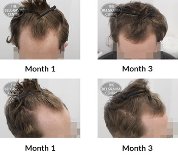 alert male pattern hair loss the belgravia centre 427413 11 11 2021