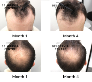 male pattern hair loss the belgravia centre 452870