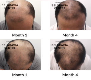 male pattern hair loss the belgravia centre 455379
