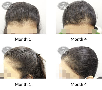alert female pattern hair loss the belgravia centre 426992 15 11 2021