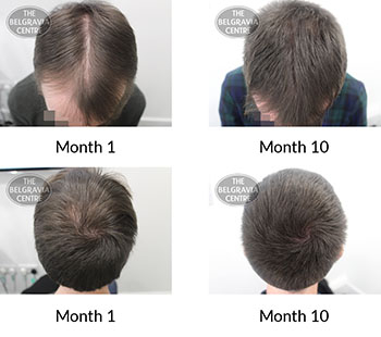 alert male pattern hair loss the belgravia centre 411251 16 08 2021