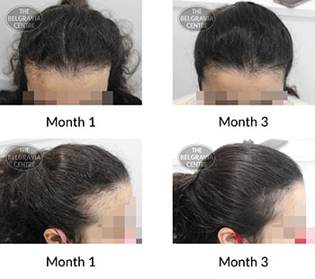 alert female pattern hair loss the belgravia centre 424103 09 09 2021