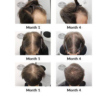 alert male pattern hair loss the belgravia centre 426338 10 11 2021