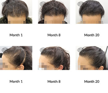 alert female pattern hair loss the belgravia centre 392566 08 07 2021