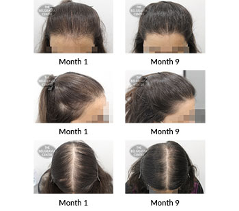 alert female pattern hair loss the belgravia centre 409845 19 07 2021
