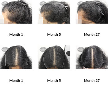 alert female pattern hair loss the belgravia centre 382509 27 07 2021
