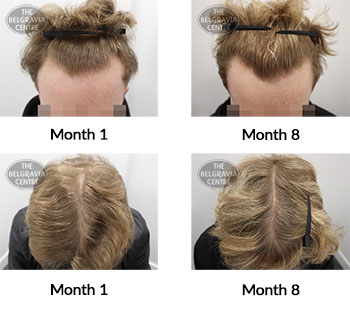 alert male pattern hair loss the belgravia centre 408301 01 07 2021