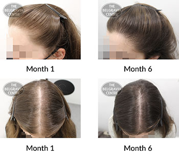 alert female pattern hair loss the belgravia centre 423252 16 11 2021