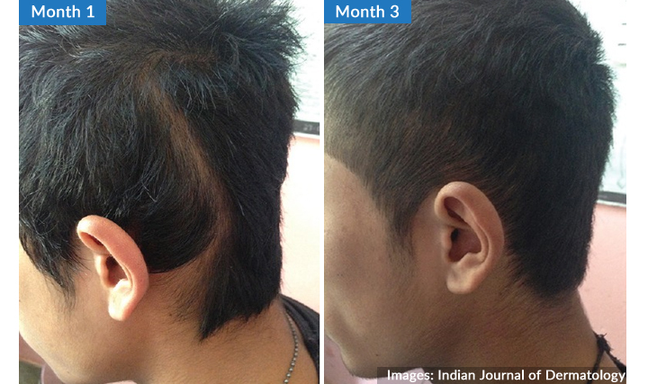 non-scarring-alopecia-in-a-linear-pattern-before-and-after-treatment
