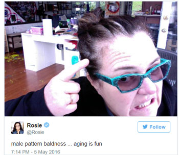 Rosie O'Donnell Women's Hair Loss
