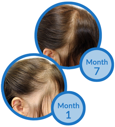 Belgravia Centre Female Pattern Hair Loss Treatment Client Success Story