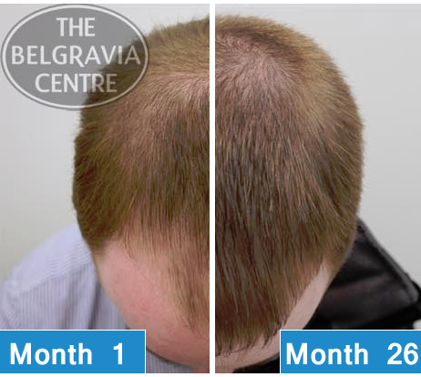 Male Hair Loss Results Following Treatment At The Belgravia Centre Hair Loss Clinic London