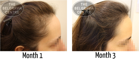 Female Pattern Hair Loss and Diffuse Thinning Treated by The Belgravia Centre