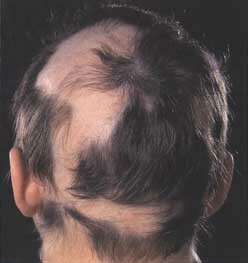 alopeciaareata