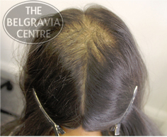 Steadily perspective Affirm hair thinning at crown female causes To deal  with the mall Ongoing
