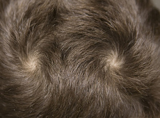 Is My Double Crown a Sign of Male Pattern Hair Loss?' Is My Double Crown a Sign of Male Pattern Hair Loss?'