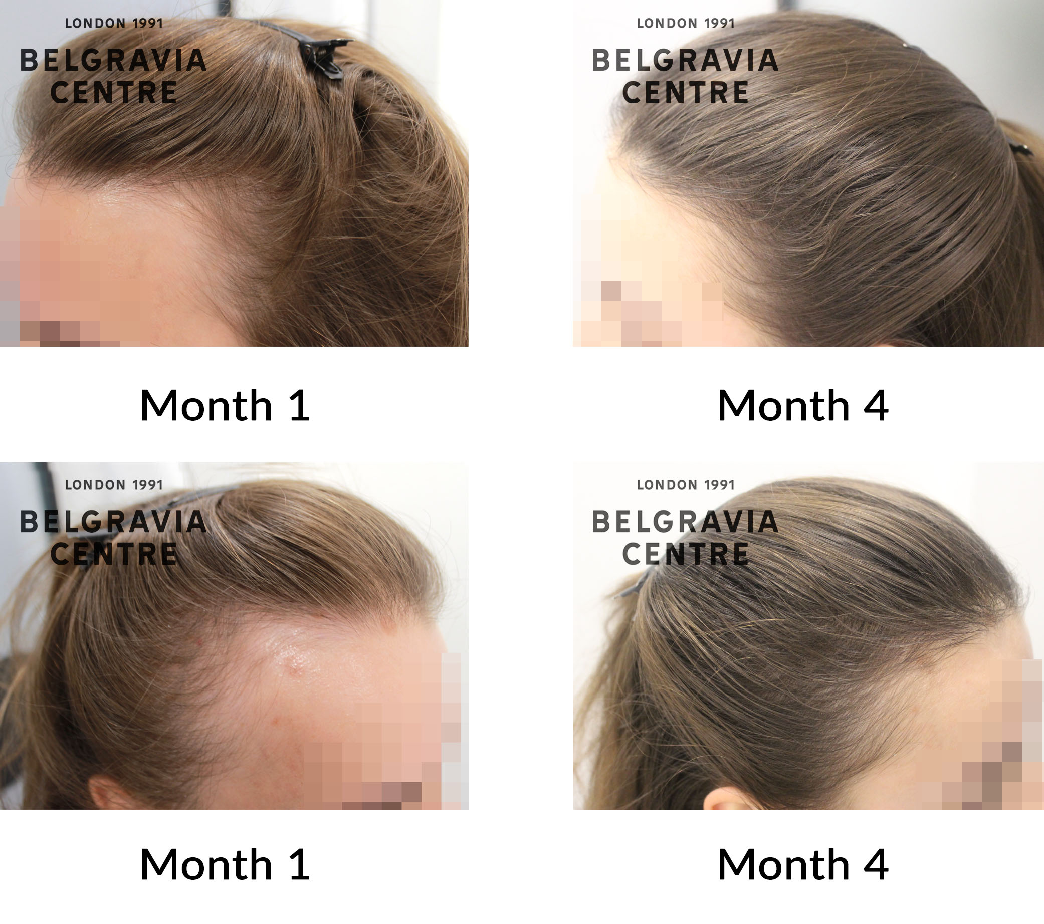 Hair Loss Success Story: Hair Loss Success Story: