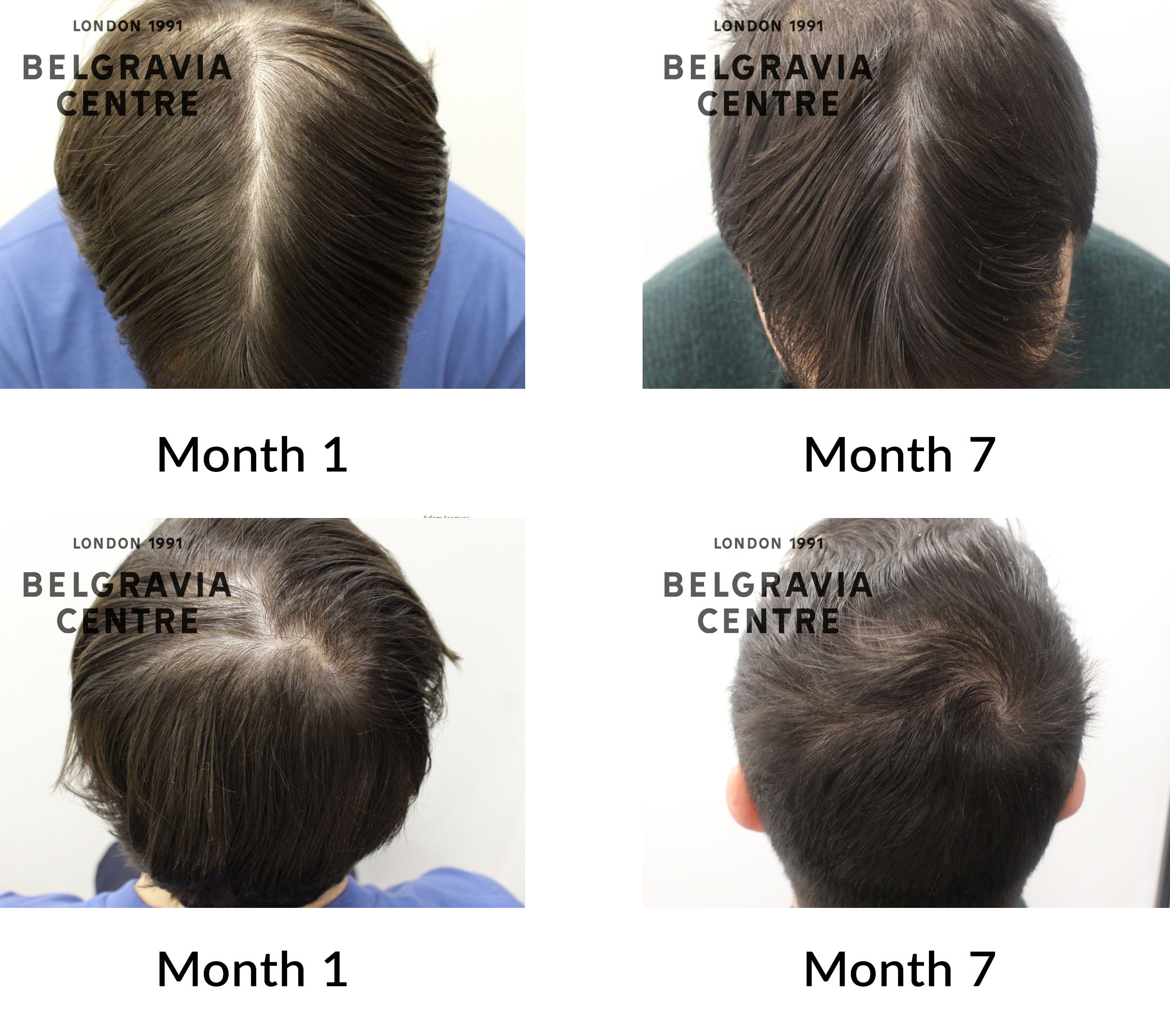 Recovery Timeline of Hair Growth after NeoGraft  Nashville Hair Doctor