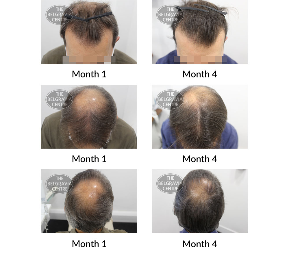Are You Ever Too Old To Grow Long Hair? How Does Age Affect The Hair Growth  Rate