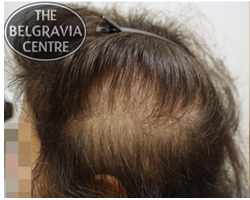 Diffuse Thinning