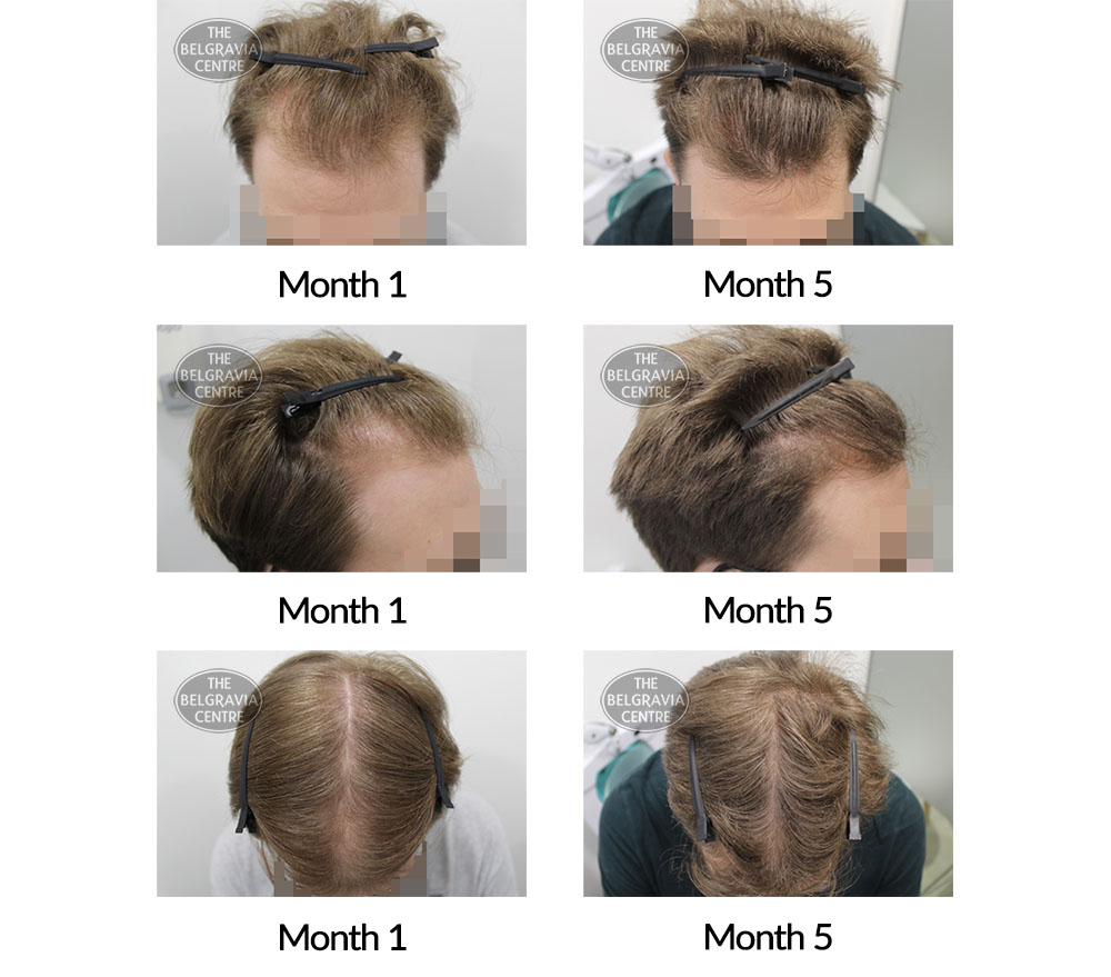 1 month discount hair growth
