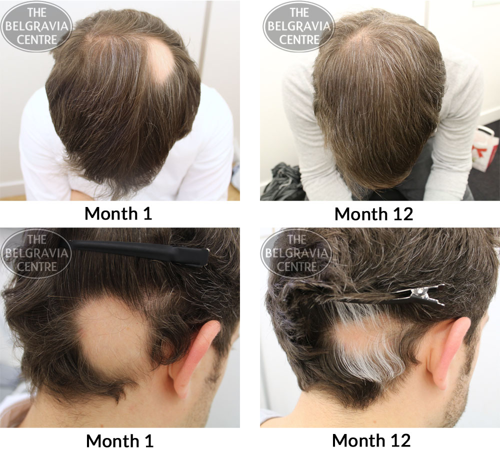 My quite massive alopecia areata has grown back