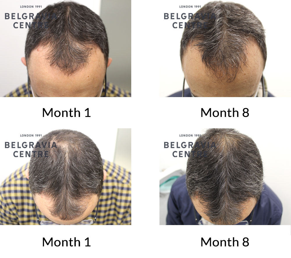Hair Growth Success Story: Hair Growth Success Story: