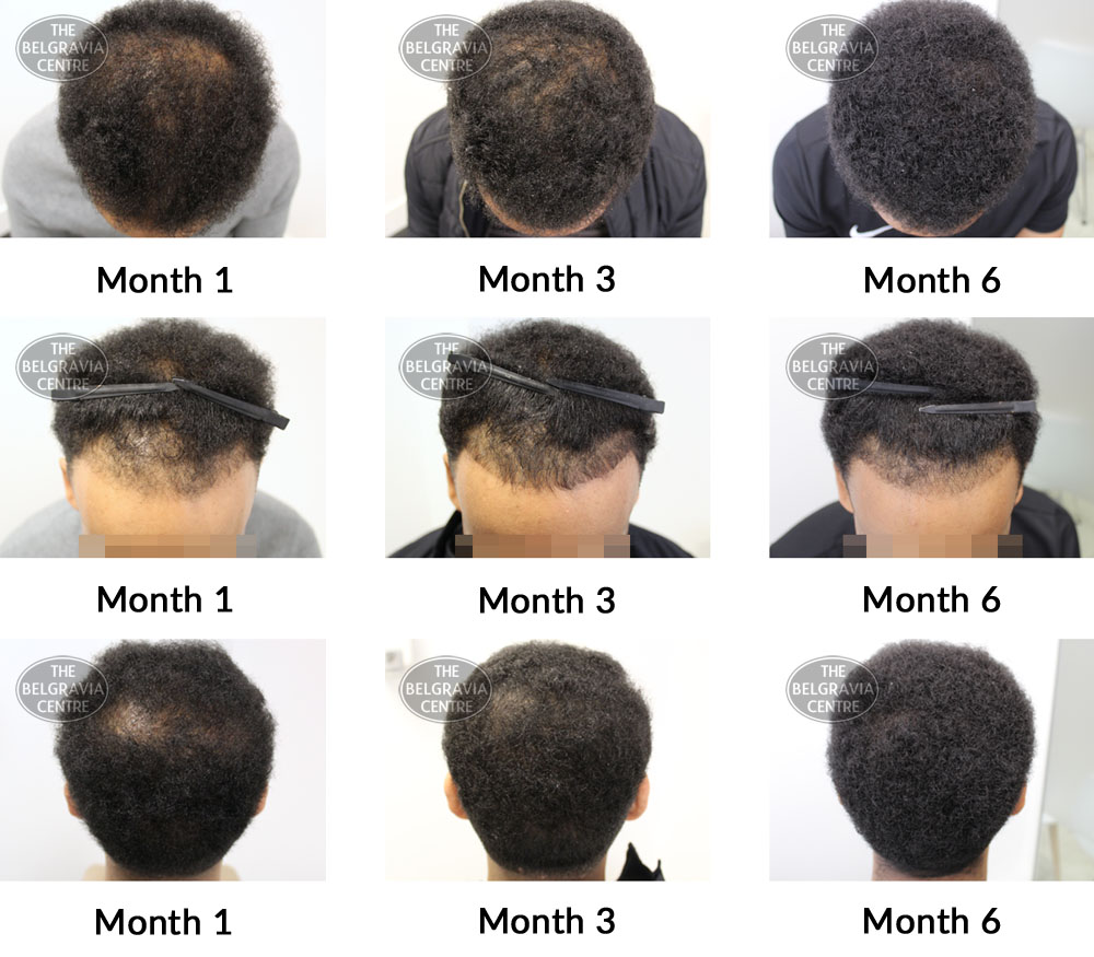 Aggregate 62+ 1 year hair growth male best - in.eteachers