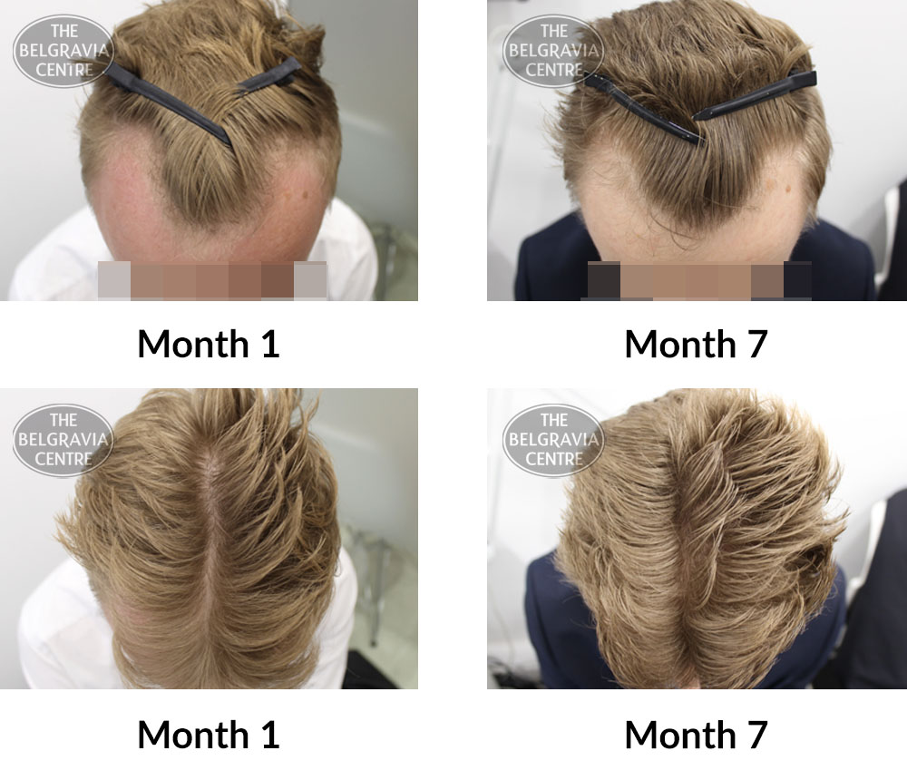 How Long Does It Take For Hair To Grow Back? – Equi Botanics