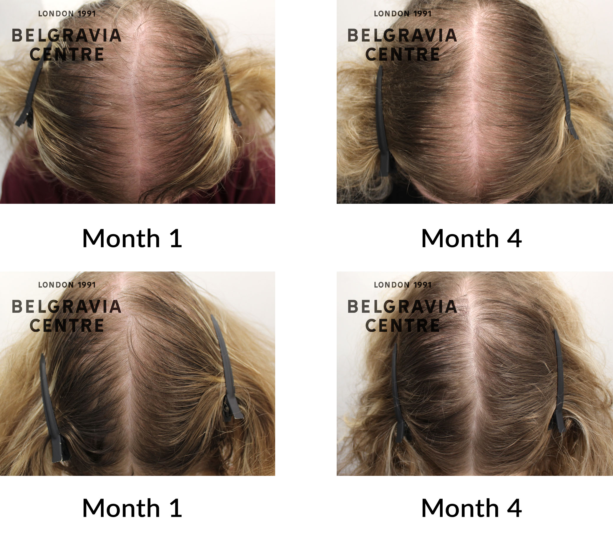 Hair Loss Success Story "I have new baby hairs growing"