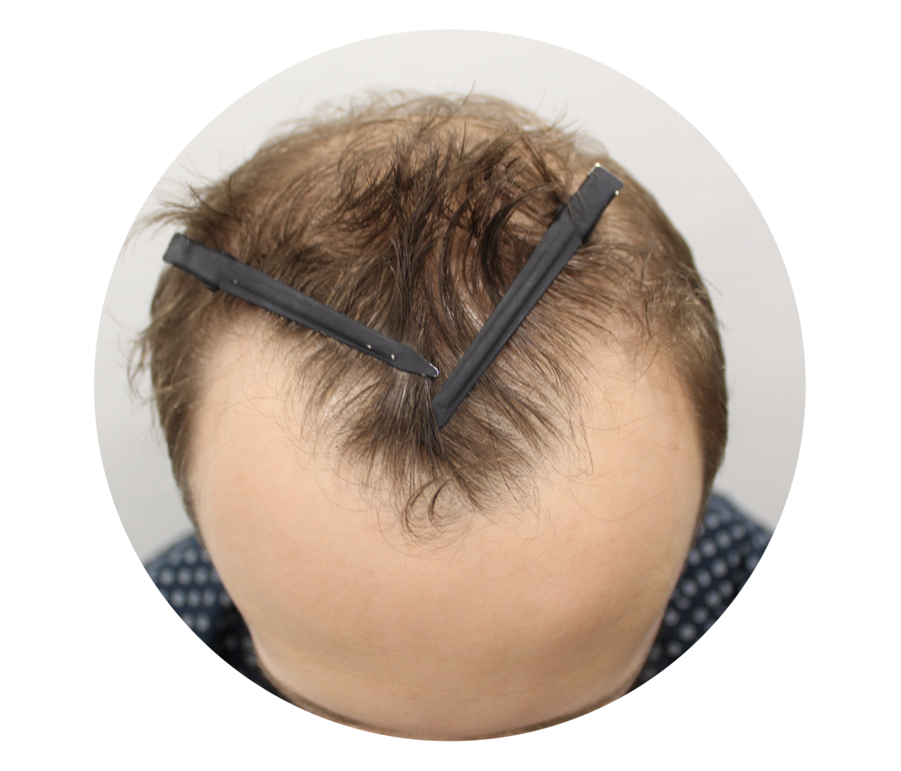 Male Hair Loss – All You Need To Know Male Hair Loss – All You Need To Know