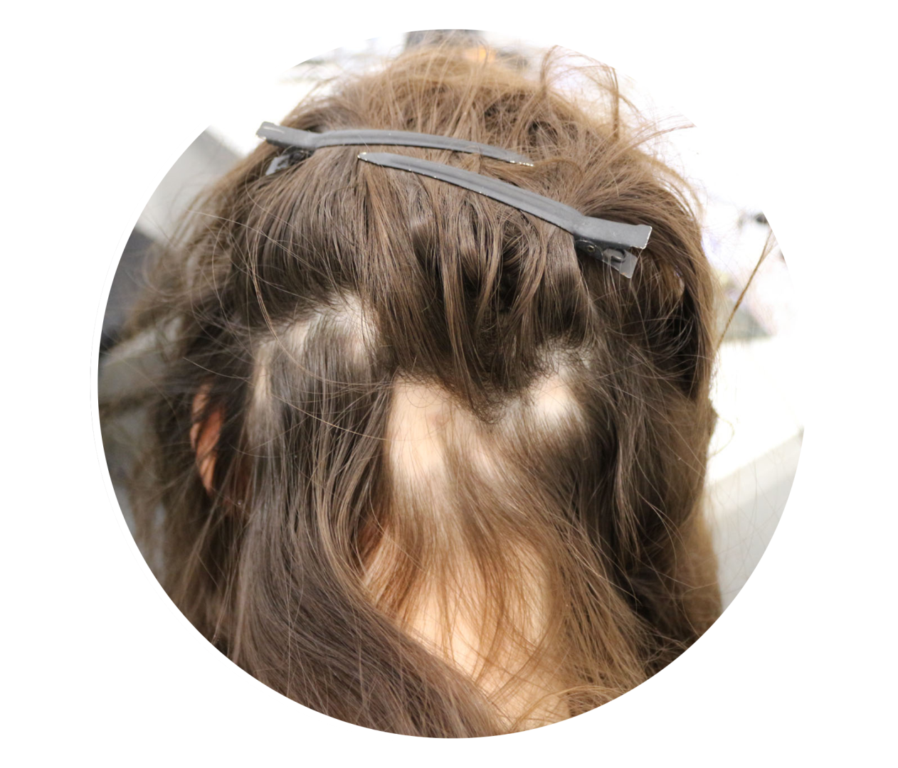 Alopecia_Areata.png