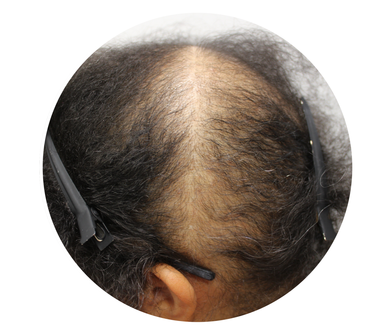 Chronic-Telogen-Effluvium.png