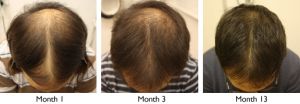 Crown-and-Receding-Hairline-Regrowth.jpeg