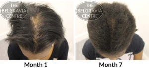 Treatment for Follicular Degeneration Syndrome at The Belgravia Centre Hair Loss Clinic London
