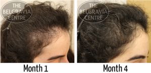 Telogen-Effluvium-Hair-Loss-Treated-by-The-Belgravia-Centre-London.jpeg