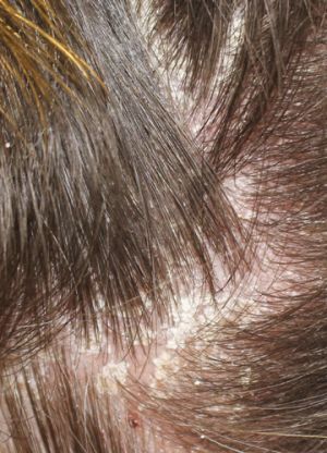 sebhorrhoeic dermatitis sebderm itchy flaky scalp