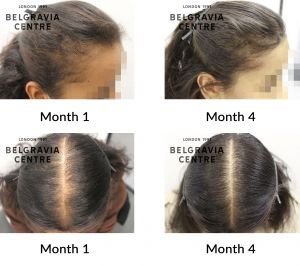 Female Hair Loss Treatments