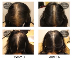 Hair Loss in Women – Female Hair Loss