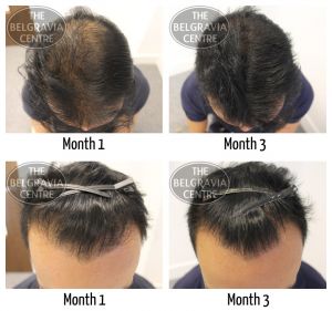 General Hair Thinning - Regrow Hair