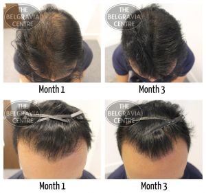 General Hair Thinning - Regrow Hair General Hair Thinning - Regrow Hair