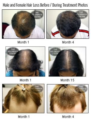 Male and Female Hair Loss Before After Photos