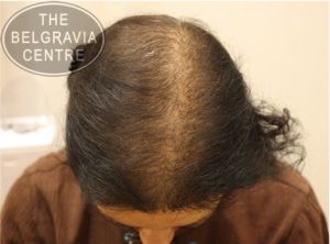 Diffuse Hair Loss – Information and Advice Diffuse Hair Loss – Information and Advice