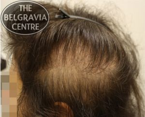 Diffuse Patterned Alopecia  Know these Hair Loss Facts