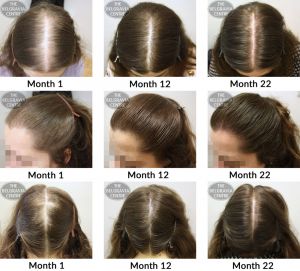 female-pattern-hair-loss-the-belgravia-centre-bc-12-04-2017.jpeg