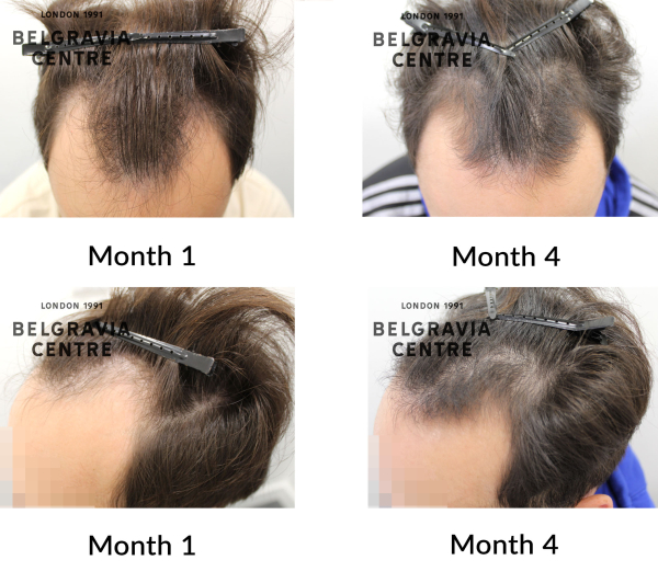 male pattern hair loss the belgravia centre 459523