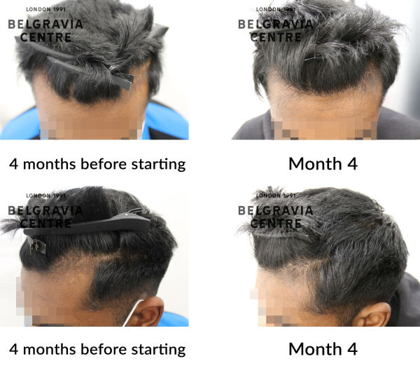 male pattern hair loss the belgravia centre 4350053