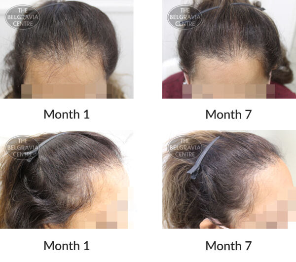 male pattern hair loss the belgravia centre 397603 07 10 2020