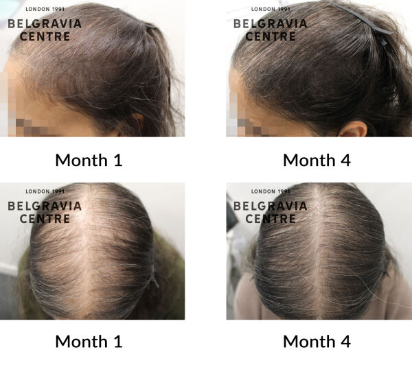 female pattern hair loss the belgravia centre 444503