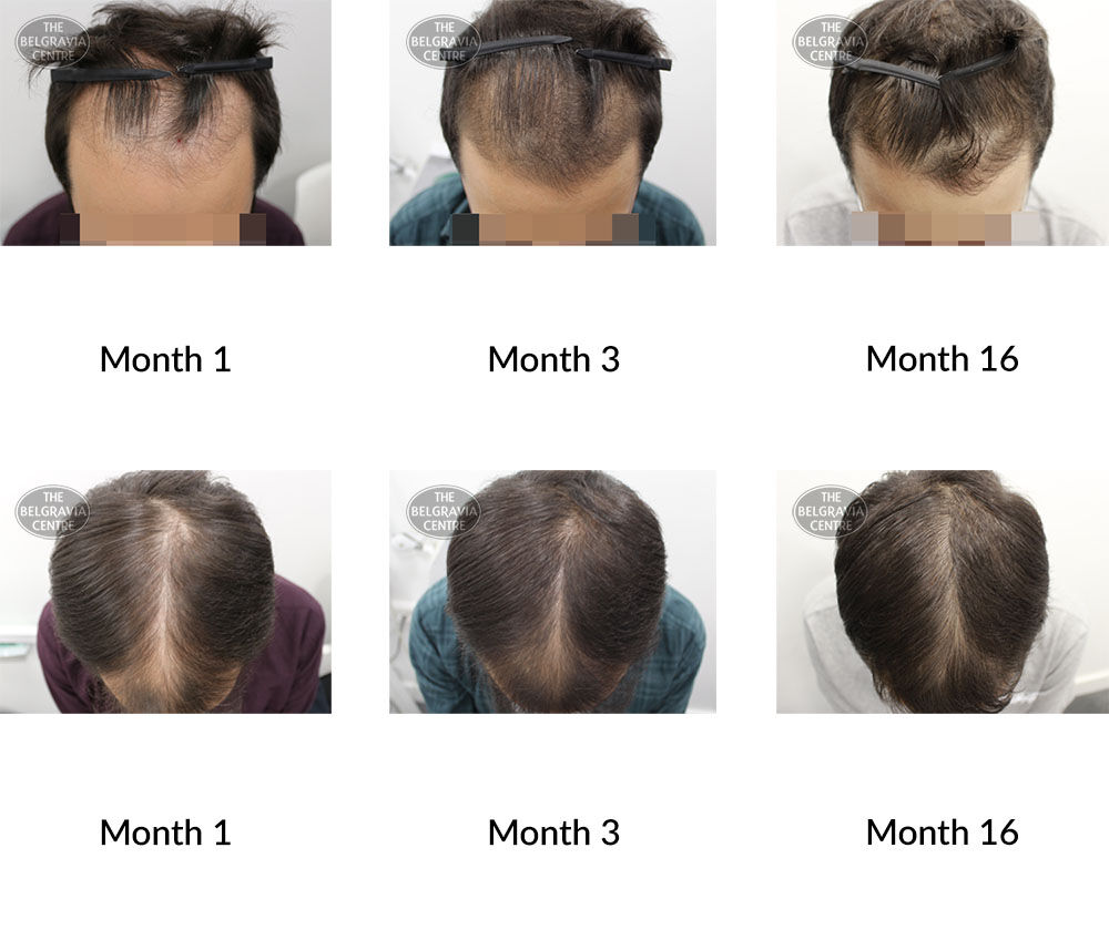 male pattern hair loss the belgravia centre 230361 27 08 2020
